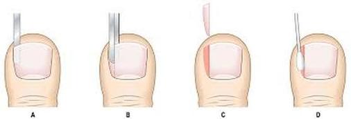 Ingrown Toenails - Barrhaven Foot Care & Orthotics