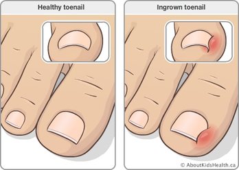 Ingrown Nails (Onychocryptosis, Ingrown toenails) - Dermatology